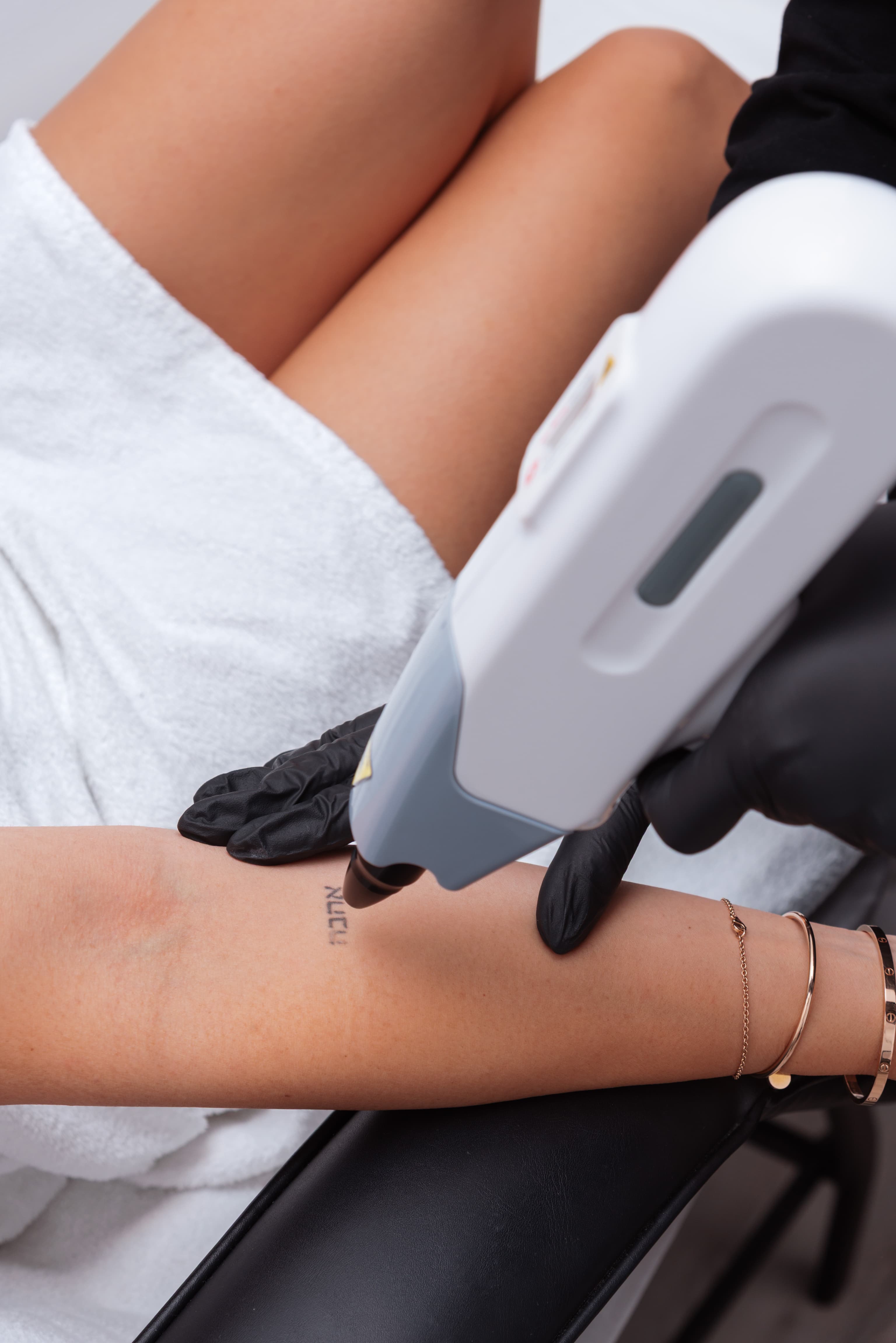 Tetoválás eltávolítás kézfejen dolgozó lézerfejjel közelről.